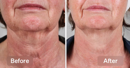 Neck Renewal Ampoule Set™